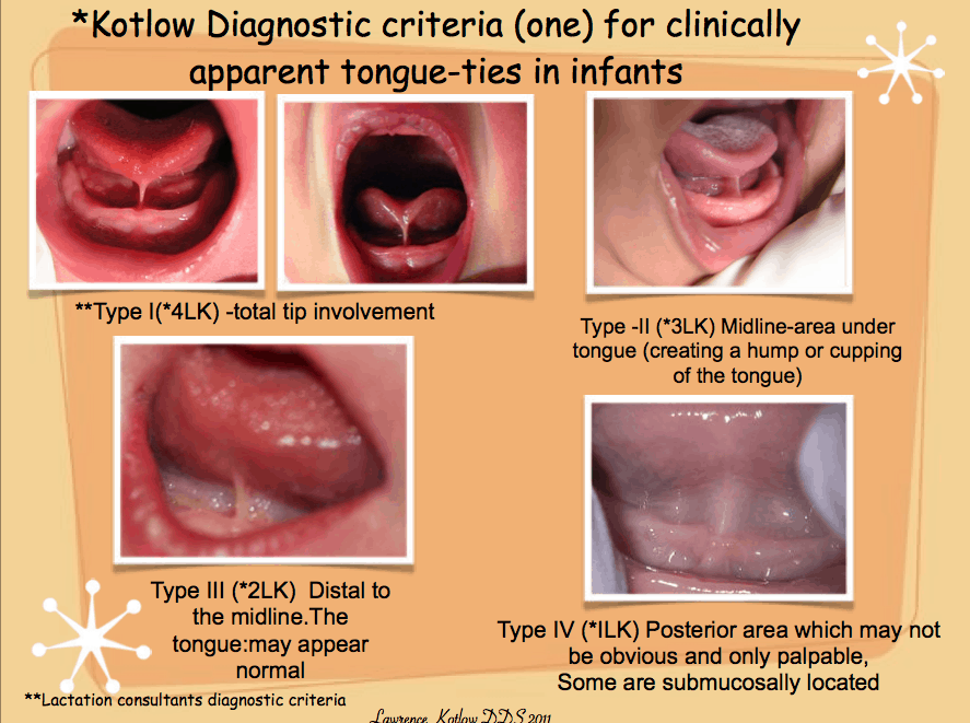 baby lip tie classifications